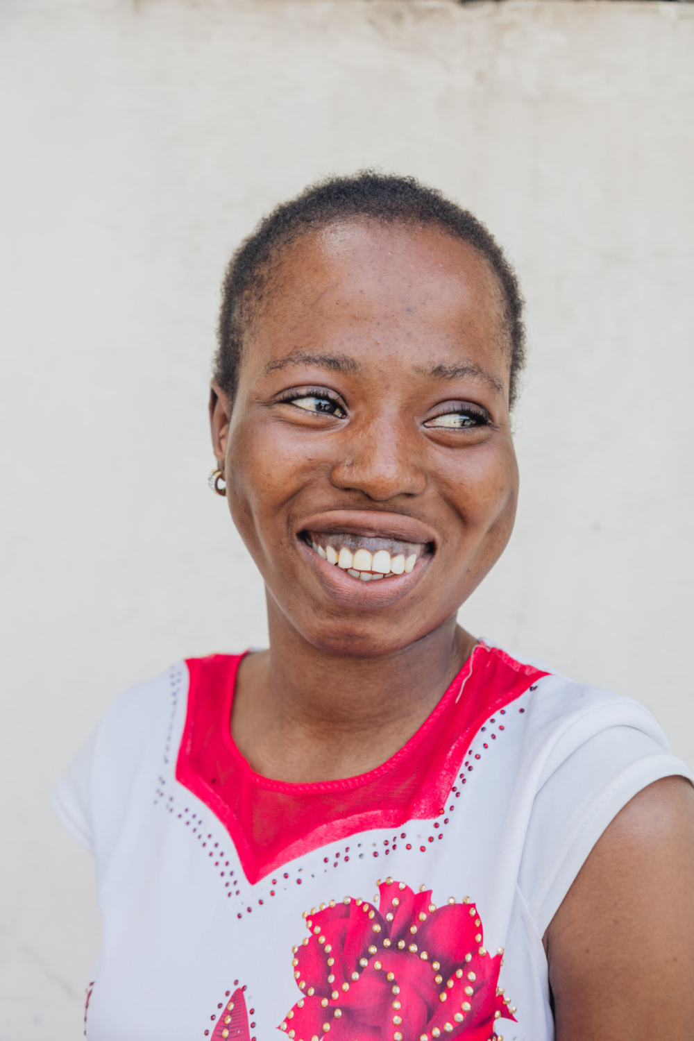 Khoudia s Story A Long Awaited Successful Surgery Mercy Ships Africa khoudia-s-story-a-long-awaited-successful-surgery-mercy-ships-africa